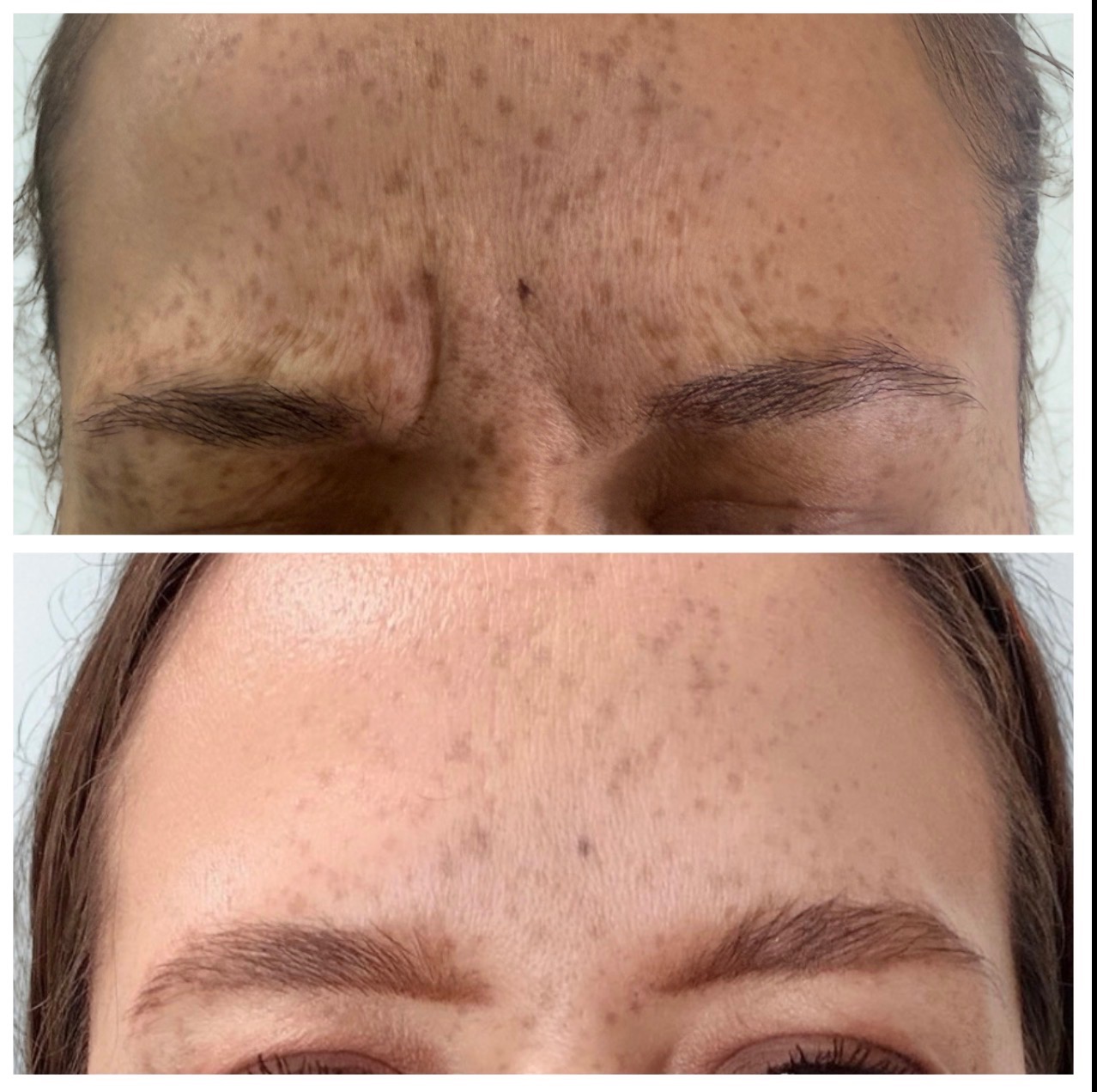 Botox before and after — forehead lines softened on a real Solas Health & Wellness patient in El Paso