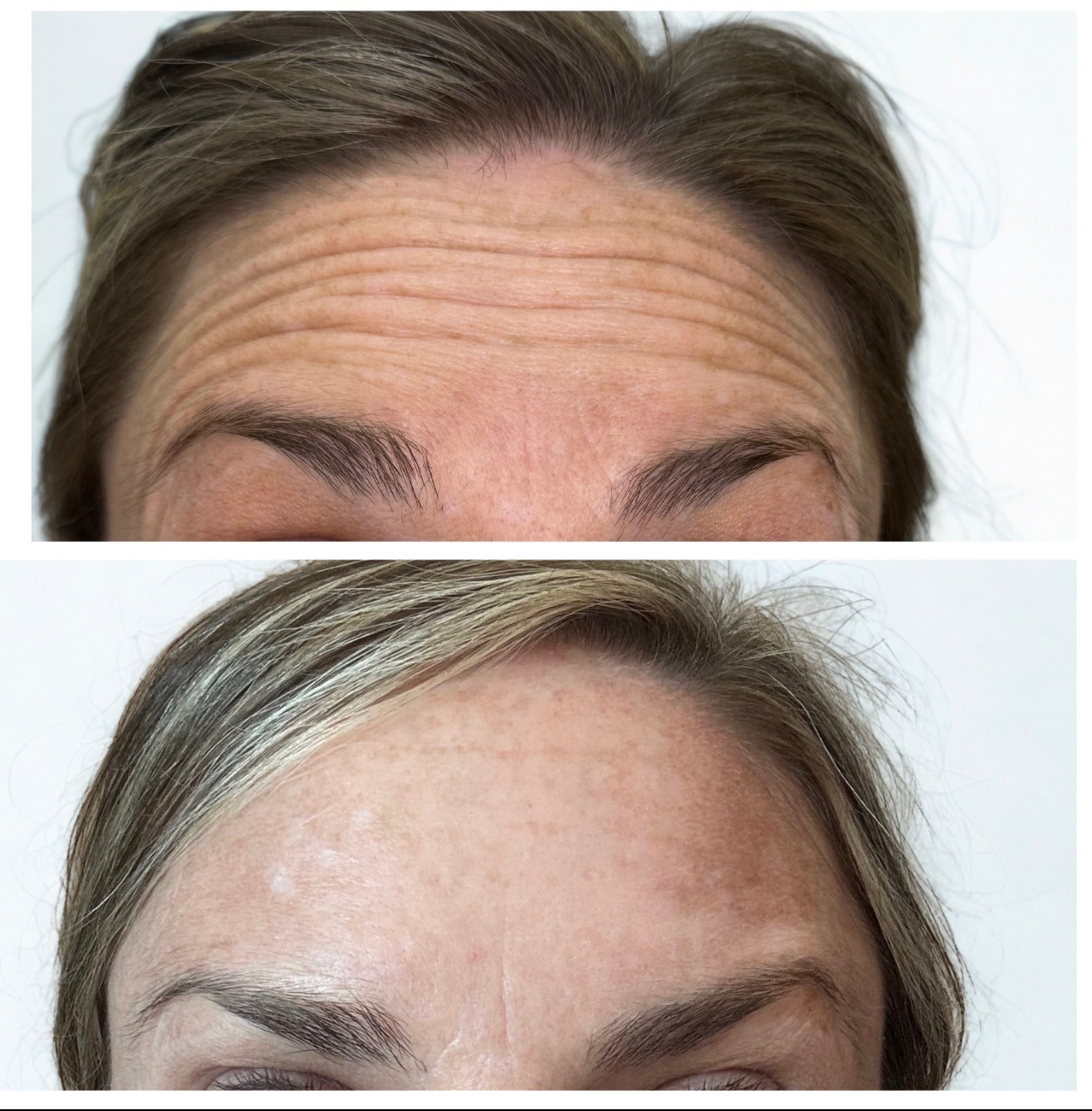 Daxxify before and after — forehead lines smoothed on a real Solas Health & Wellness patient in El Paso